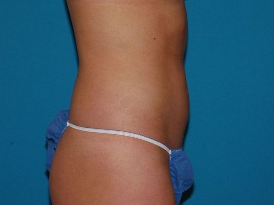 Carmel Cosmetic & Plastic Surgeons' Patient after liposuction procedure